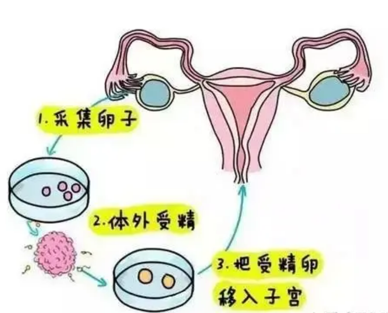 试管婴儿VS人工授精，哪个更适合我呢？