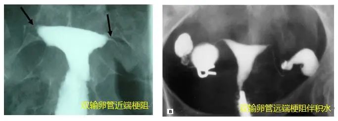检查发现输卵管有问题，下一步应该怎么做呢？