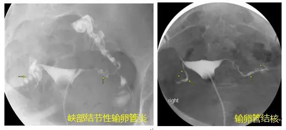检查发现输卵管有问题，下一步应该怎么做呢？