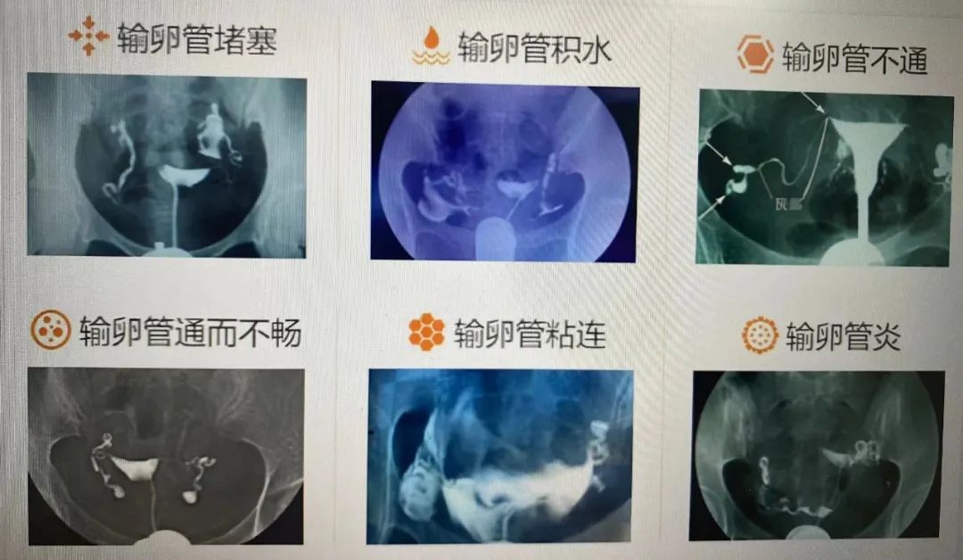 输卵管通畅程度如何评估？